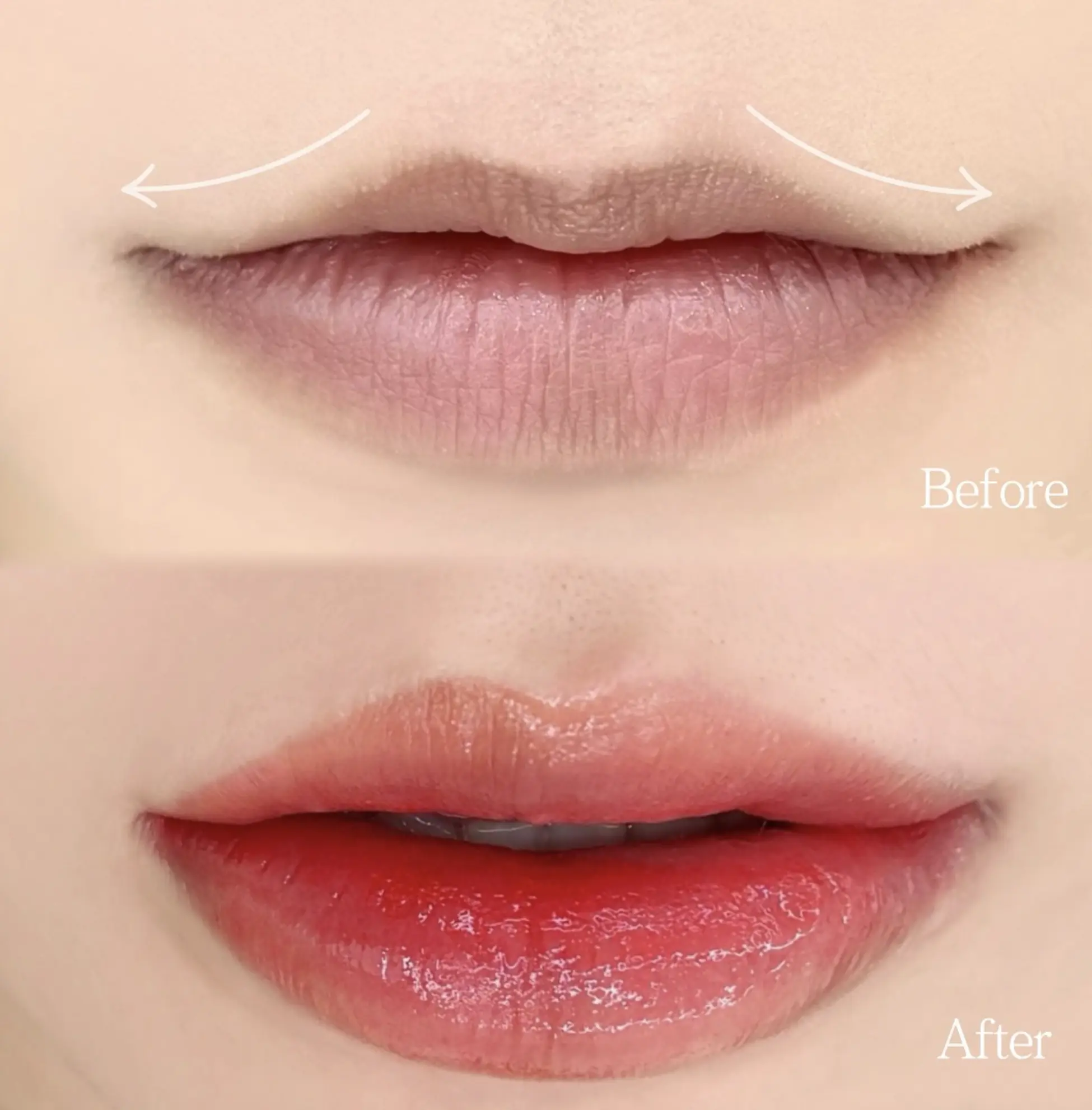 Swollen lips after cosmetic tattooing
